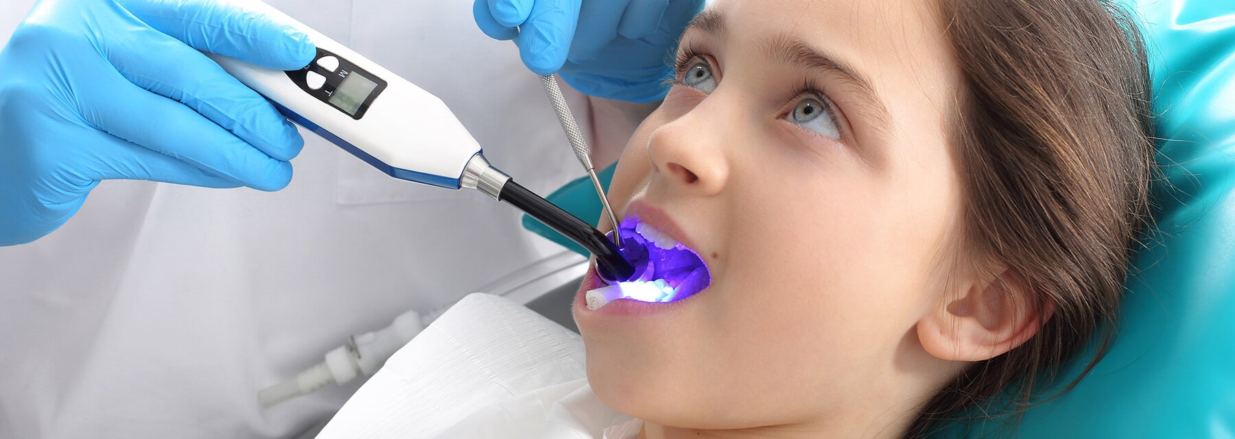Dental Sealants - FRANK P. SCARTOZZI, D.D.S., Closter, New Jersey