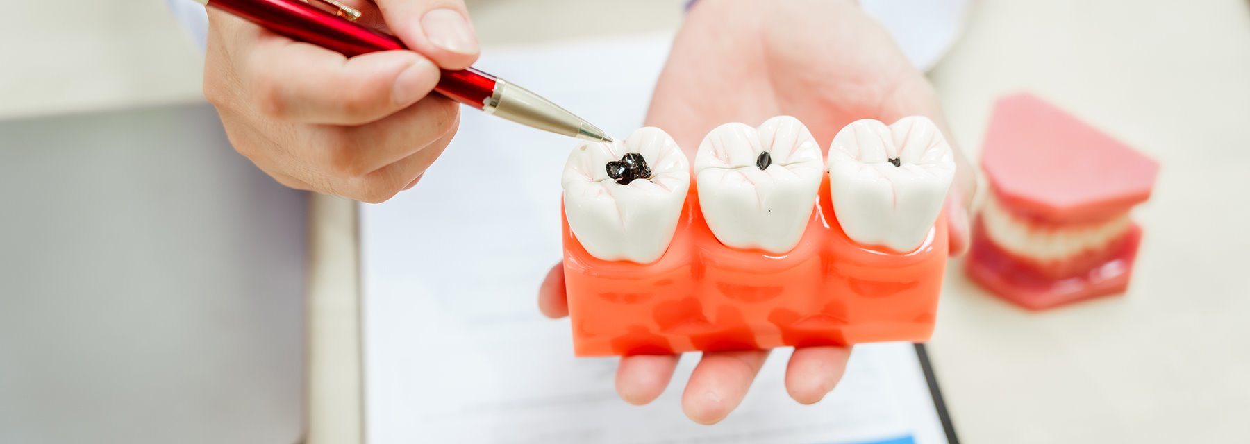 Tips to Prevent Cavities - FRANK P. SCARTOZZI, D.D.S., Closter, New Jersey